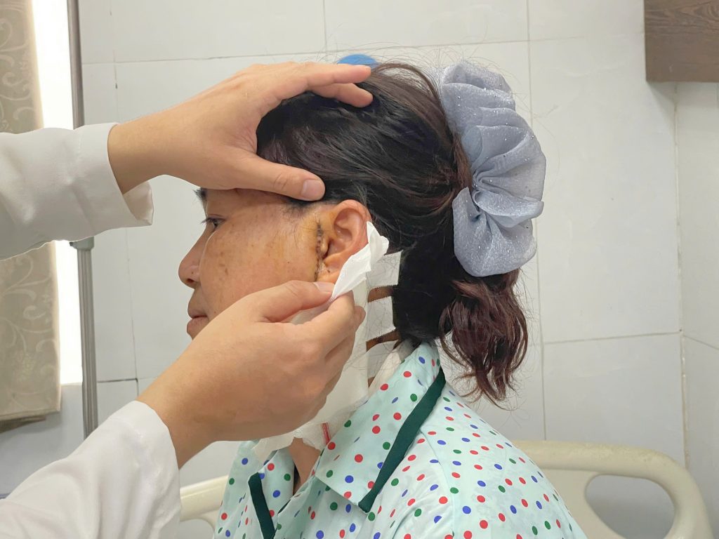 Hình ảnh vết mổ sau phẫu thuật u tuyến mang tai