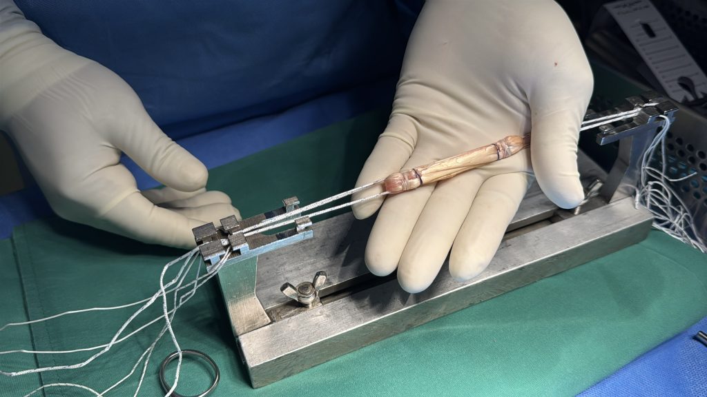 Gân mác dài để thay thế Dây chằng chéo trước bị đứt
