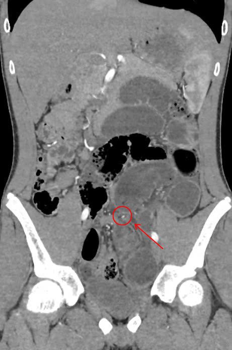 Hình ảnh CT ổ bụng cho thấy bệnh nhân bị dính ruột
