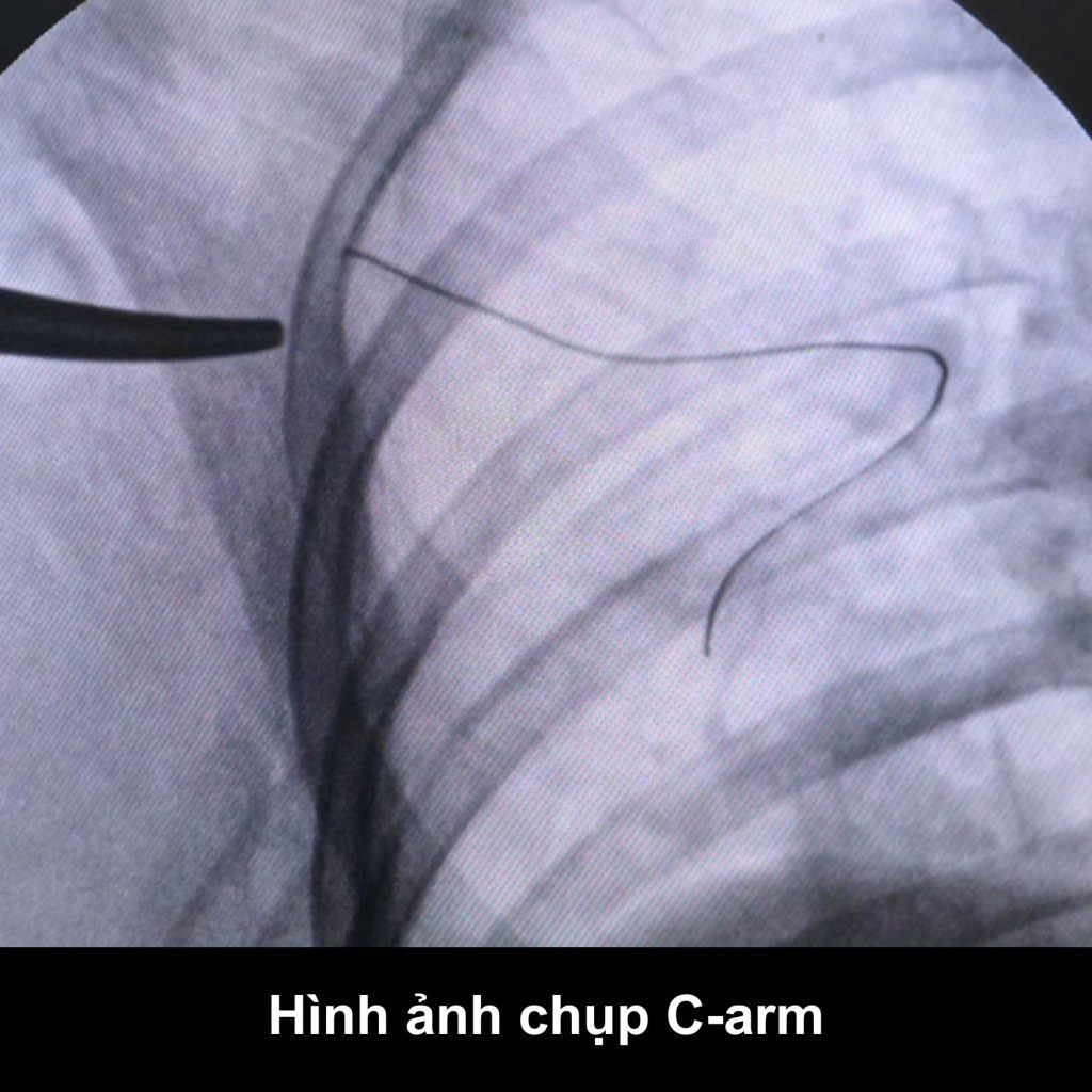 Hình ảnh quá trình can thiệp cho thấy nguyên nhân làm bệnh nhân khó thở