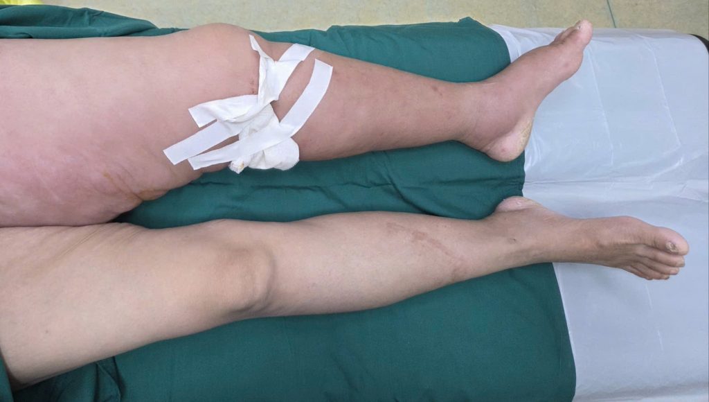 Hình ảnh chân trái bệnh nhân sưng to trước kkhi điều trị