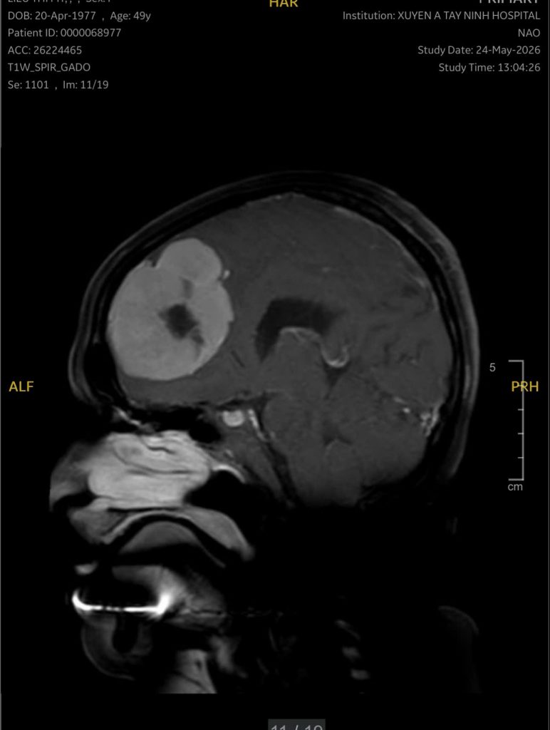 Hình ảnh phim MRI não (Khối u là phần trắng)
