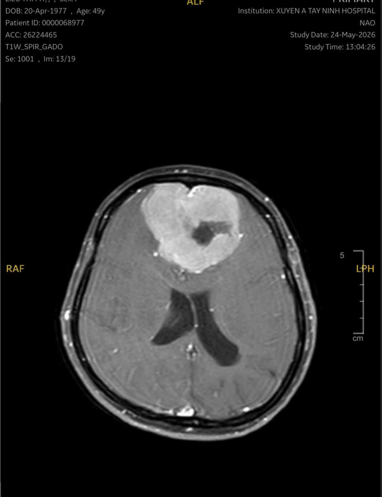 Hình ảnh phim MRI não (Khối u là phần trắng)