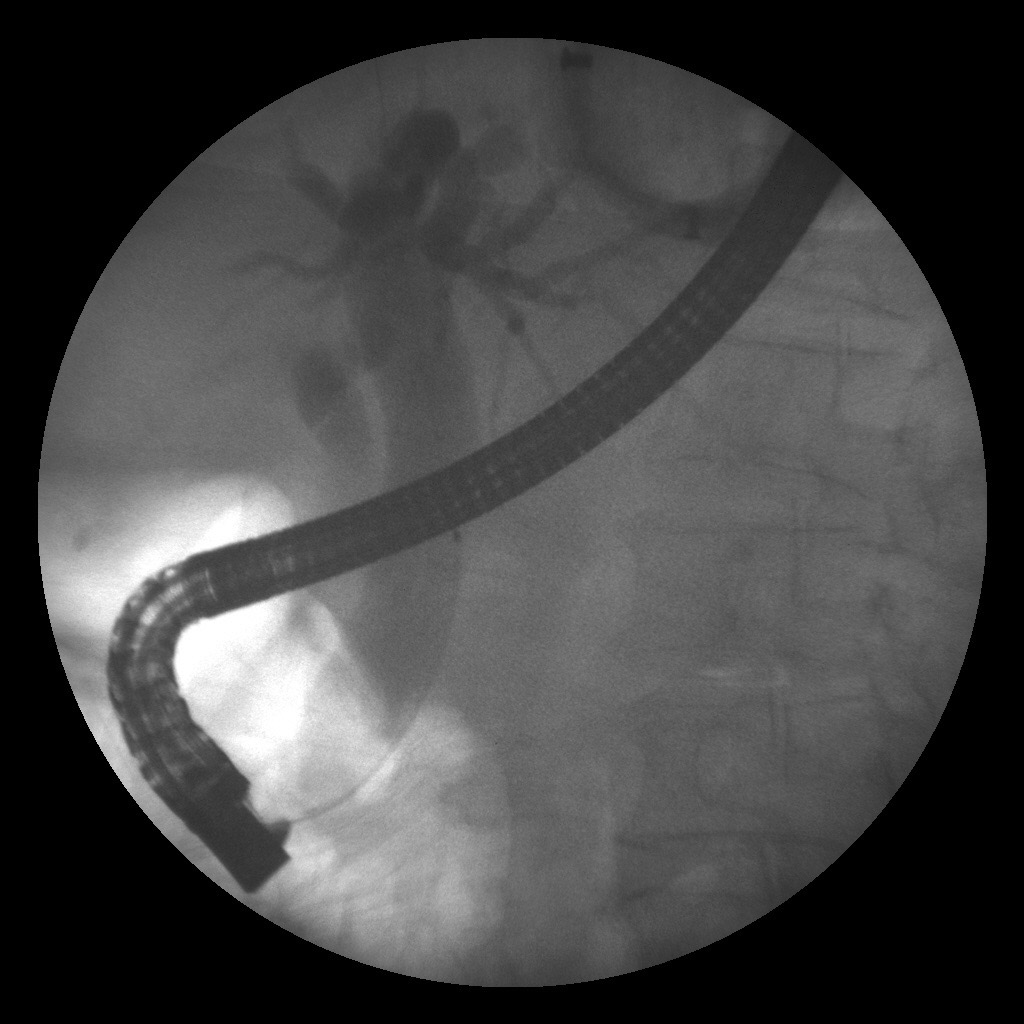 Hình ảnh stent dẫn lưu đường mật nhằm đảm bảo lưu thông dịch mật