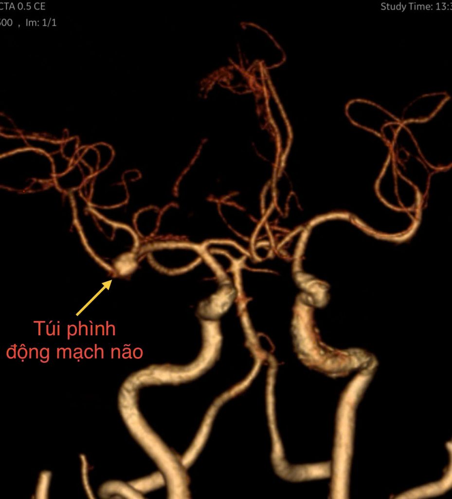 Hình ảnh túi phình trên phim CTA