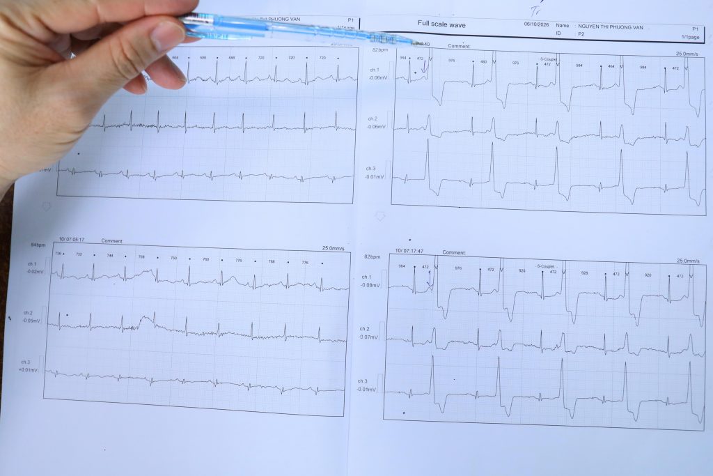 Hình ảnh rối loạn nhịp tim trước can thiệp