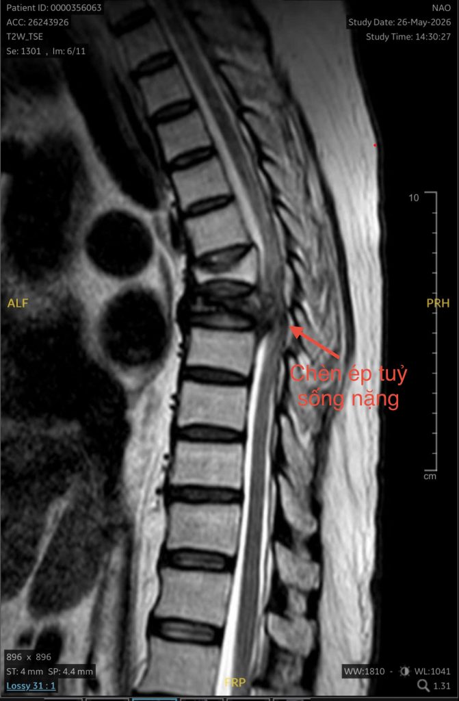 Hình ảnh phim MRI cho thấy xẹp đốt sống chèn ép tuỷ sống
