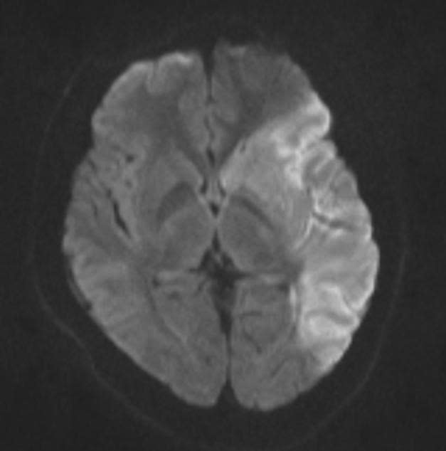 Phim MRI ca bệnh nhồi máu não ở thanh niên 18 tuổi