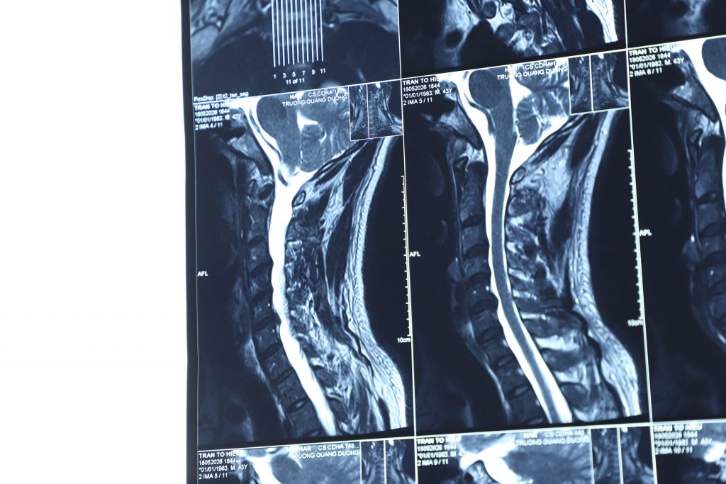 Hình ảnh phim MRI vị trí thoát vị đĩa đệm cột sống cổ