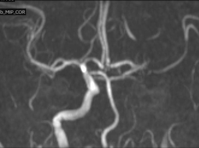 Phim MRI vùng nhồi máu não