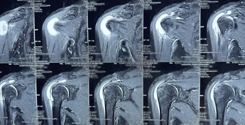 Hình ảnh phim MRI của bệnh nhân rách chóp xoay