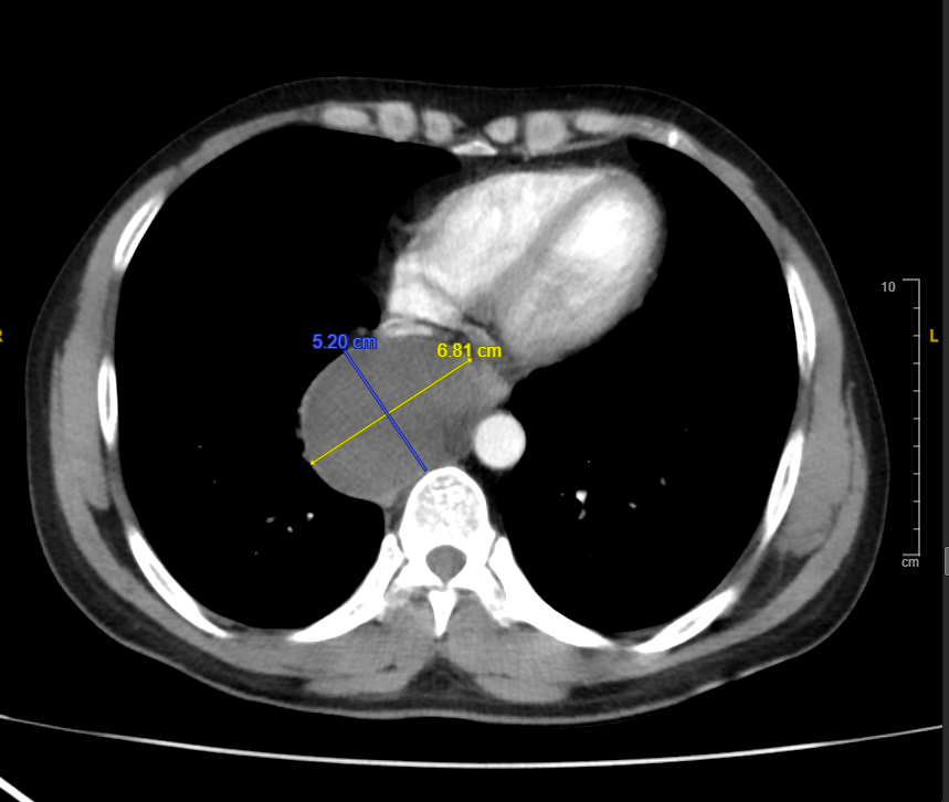 Hình ảnh MRI khối u trung thất