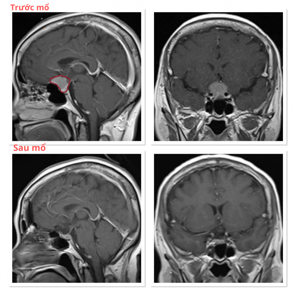 Hình ảnh MRI trước và sau mổ