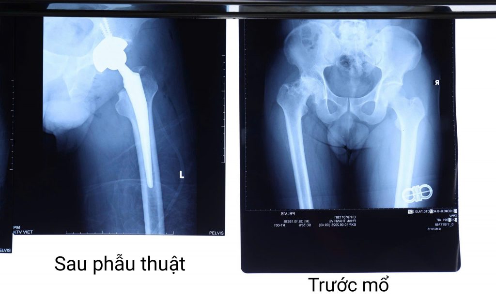 Hình chụp x-quang khớp háng trước và sau phẫu thuật của bệnh nhân bị hoại tử chỏm xương đùi