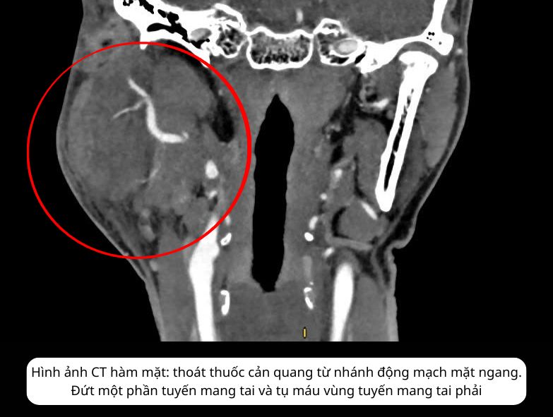 Hình ảnh CT hàm mặt