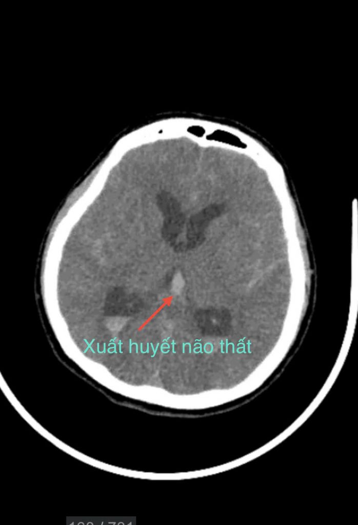 Hình ảnh MSCT não