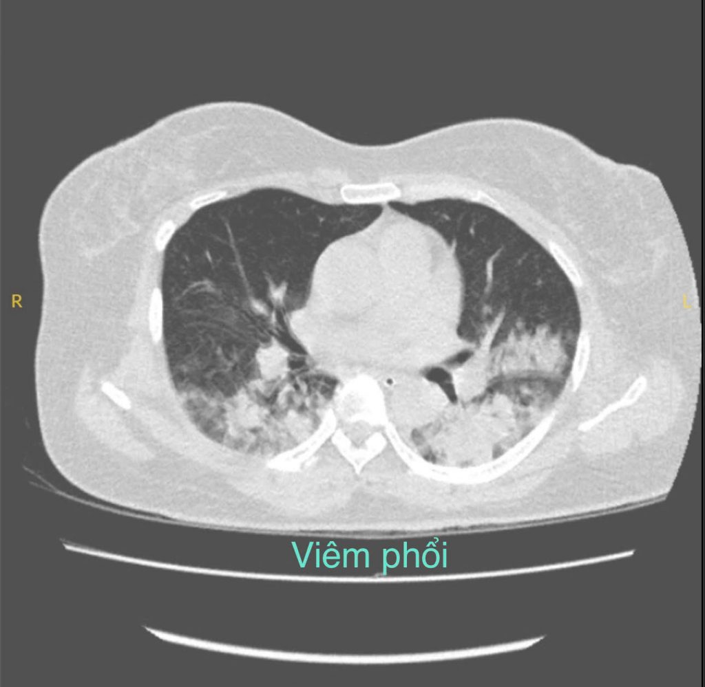 Hình ảnh viêm phổi khi nhập viện