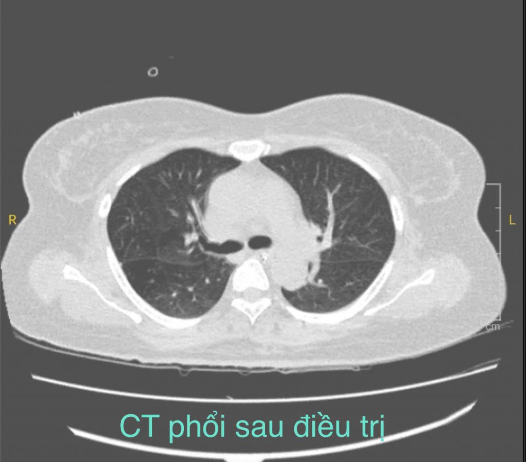 Hình ảnh viêm phổi sau điều trị