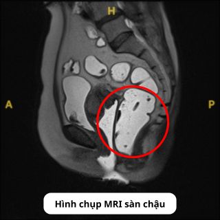 Hình chụp MRI sàn chậu