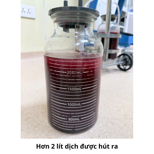 Hình ảnh dịch được hút ra