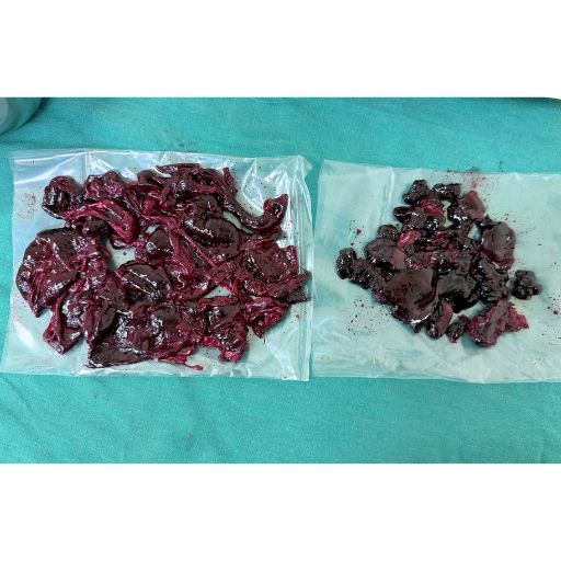 Hình ảnh khối u buồng trứng