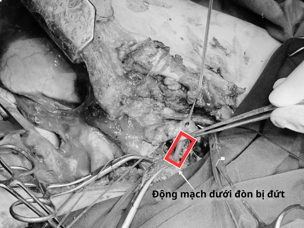 Động mạch dưới đòn bị đứt