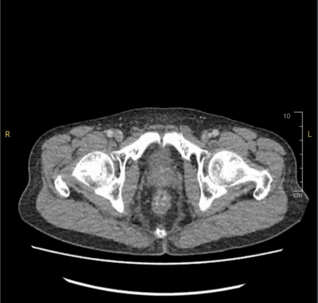 Hình ảnh CT khối ưng thư trực tràng thấp