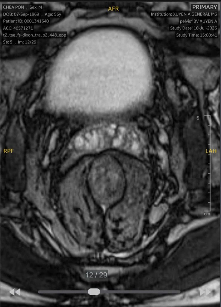 Hình ảnh CT khối ưng thư trực tràng thấp