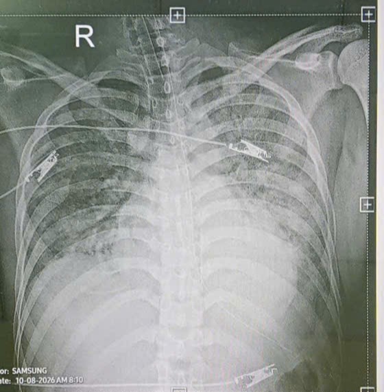 Hình ảnh CT phổi cho thấy tổn thương và phải đặt máy thở do suy hô hấp