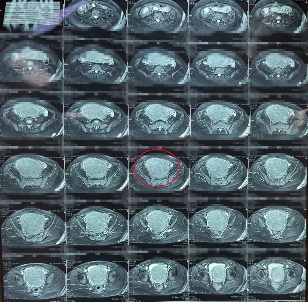 Hình ảnh MRI ghi nhận khối u tử cung của bệnh nhân