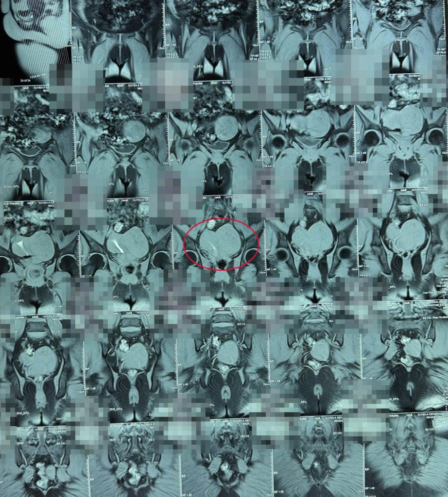 Hình ảnh MRI xác định BN có khối u xơ tử cung kích thước lớn, tương đương thai 14 tuần tuổi