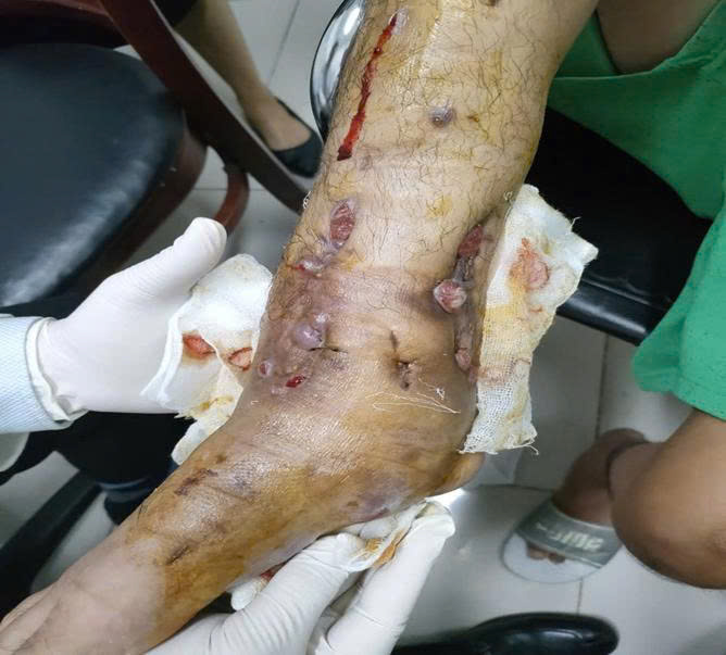 Hình ảnh chân khi nhập viện