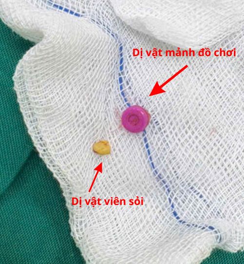 Hình ảnh dị vật được lấy ra