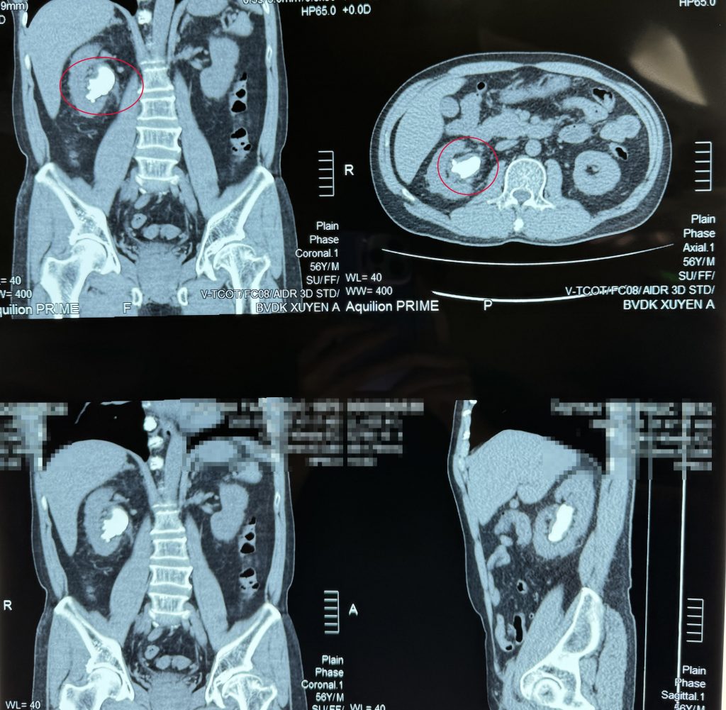 Hình ảnh phim CT-scan của bệnh nhân phát hiện sỏi san hô