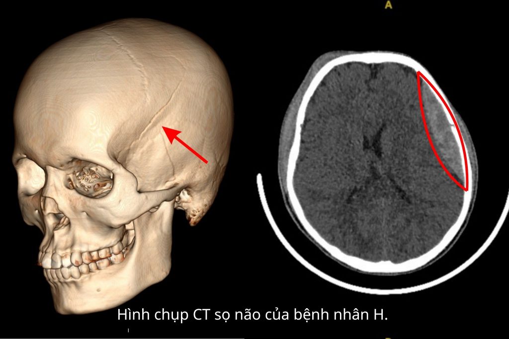 Hình chụp CT sọ não bn H bị tai nạn giao thông