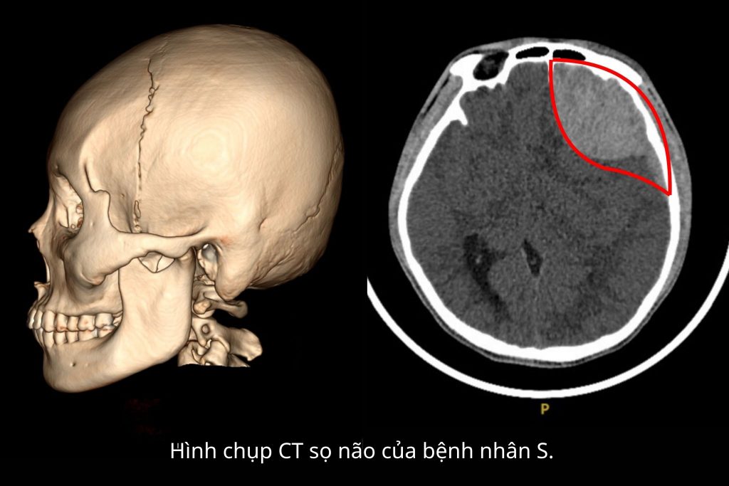 Hình chụp CT sọ não bn S bị tai nạn giao thông