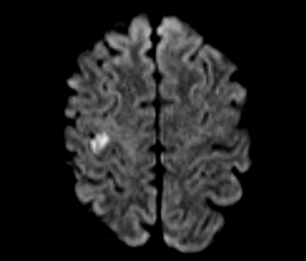 Hình tổn thương não trên phim MRI của bệnh nhân bị đột quỵ khi đang du lịch