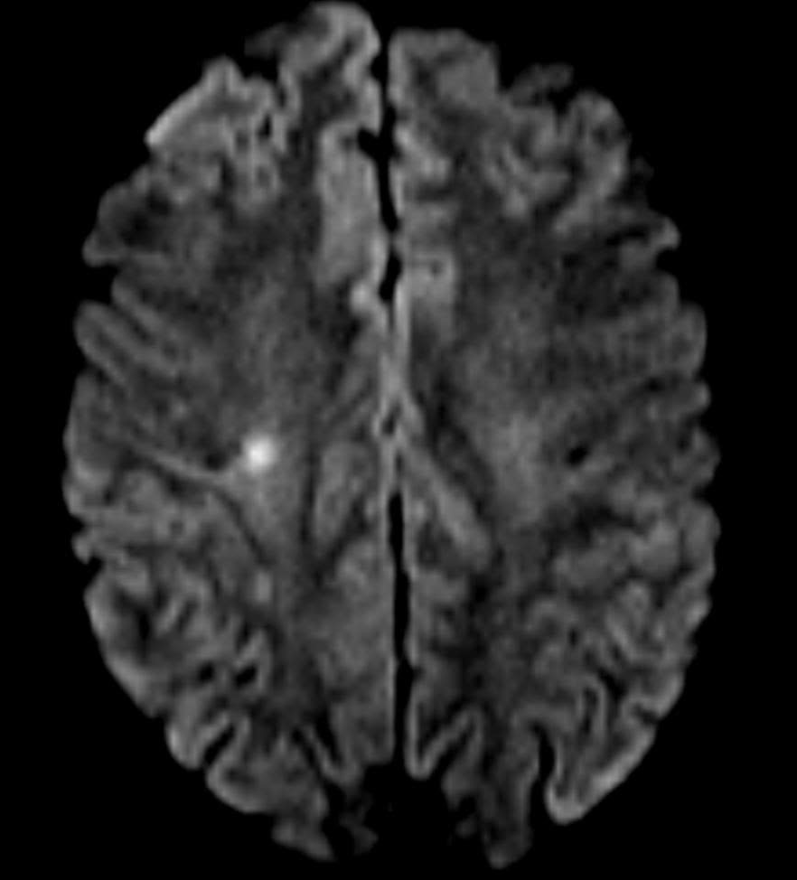 Hình tổn thương não trên phim MRI của bệnh nhân bị đột quỵ khi đang du lịch
