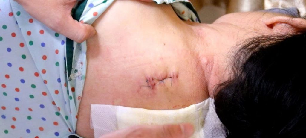Hình ảnh vết mổ nhỏ sau phẫu thuật u tuỷ ngực, xâm lấn tối thiểu