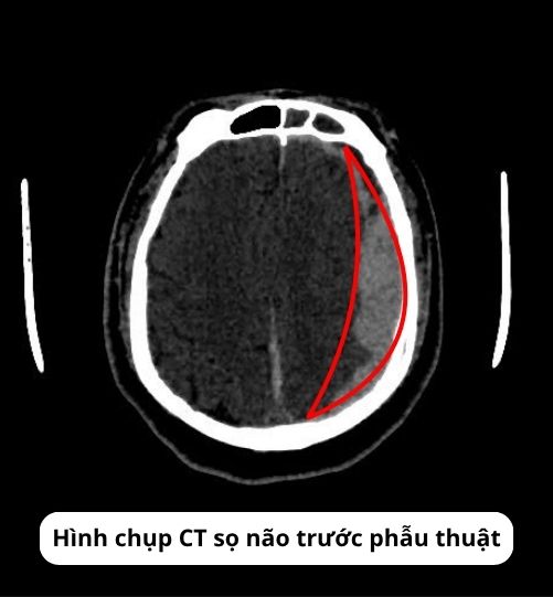 Ảnh CT trước phẫu thuật của bệnh nhân chấn thương sọ não sau cú đánh vào đầu