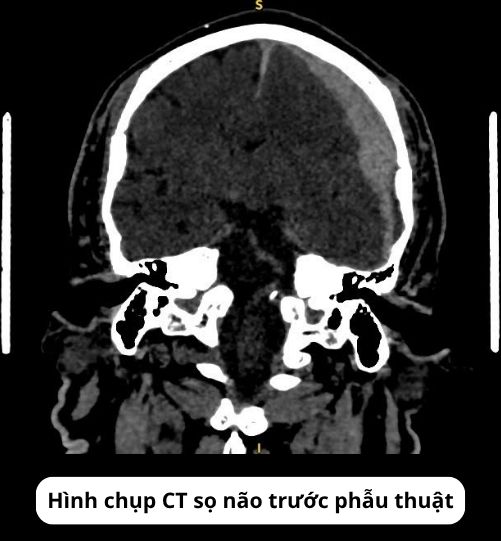 Ảnh CT trước phẫu thuật của bệnh nhân chấn thương sọ não sau cú đánh vào đầu