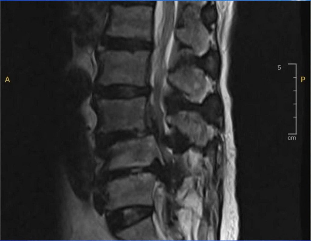 Hình MRI cột sống thắt lưng ghi nhận ổ áp xe ngoài màng cứng