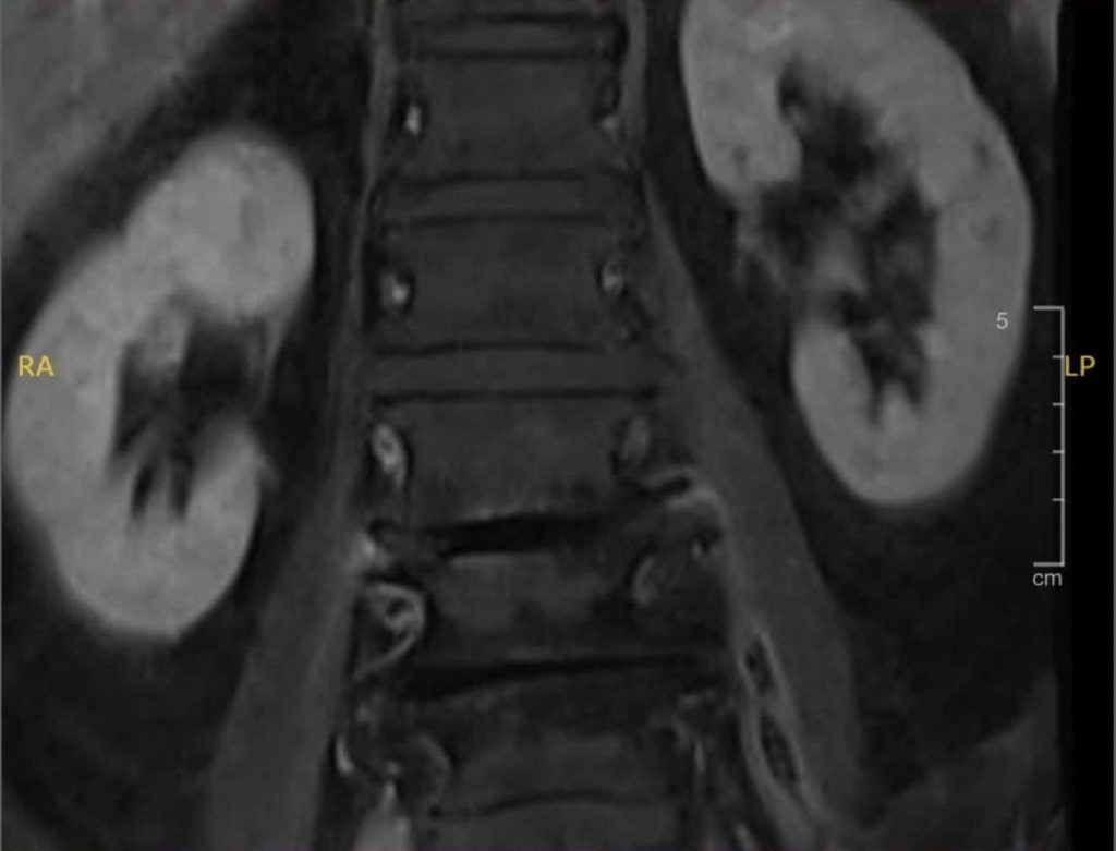 Hình MRI cột sống thắt lưng ghi nhận ổ áp xe ngoài màng cứng.
