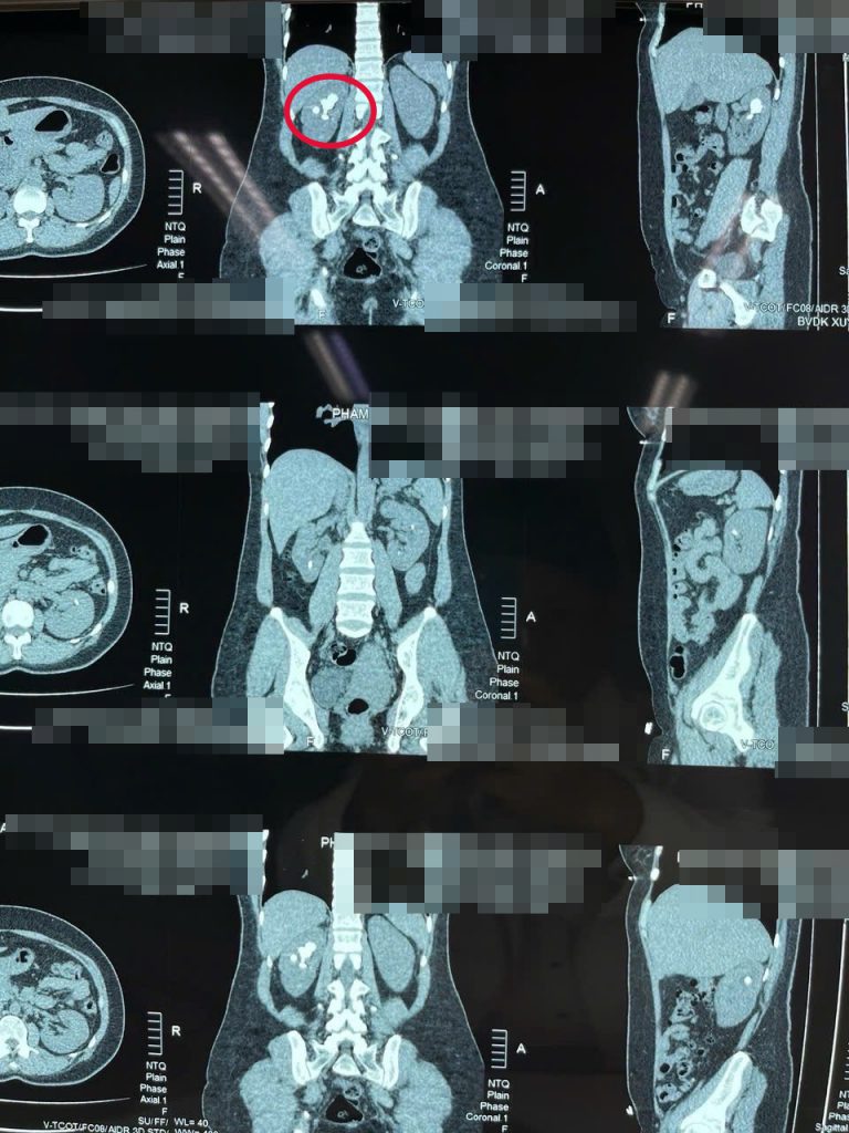 Hình ảnh phim CT của bệnh nhân tăc động mạch đùi