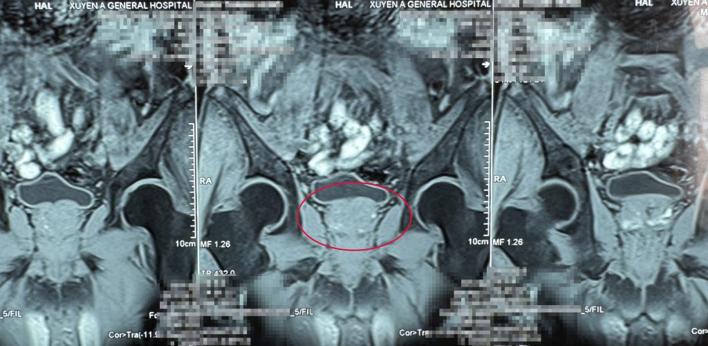 Hình ảnh phim MRI của bệnh nhân phẫu thuật cắt tuyến tiền liệt