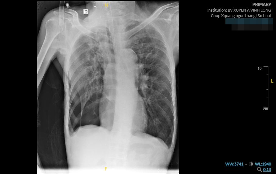 Hình ảnh phim Xquang của bệnh nhân COPD