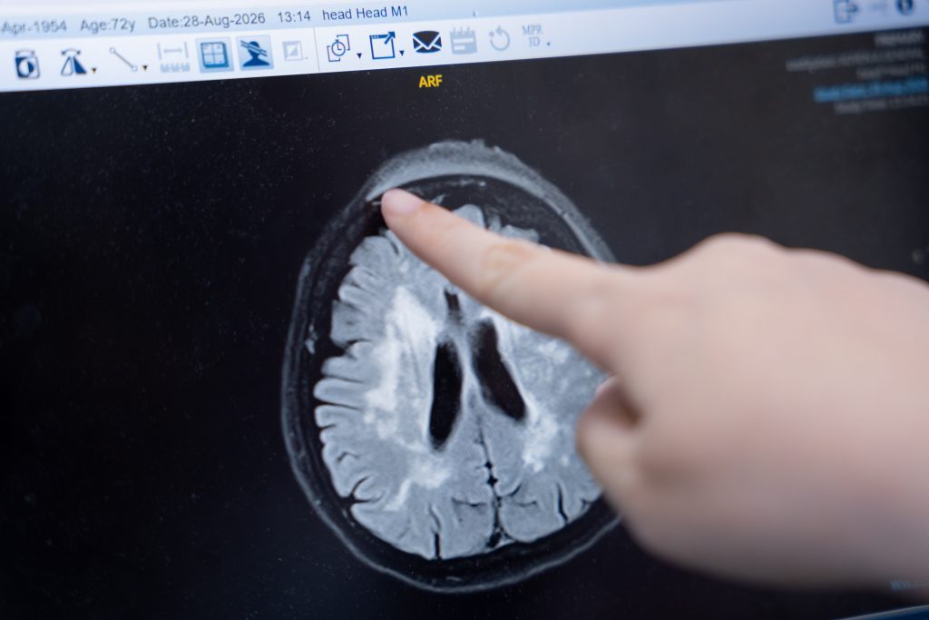 Phim MRI vị trí viêm não tuỷ do zona