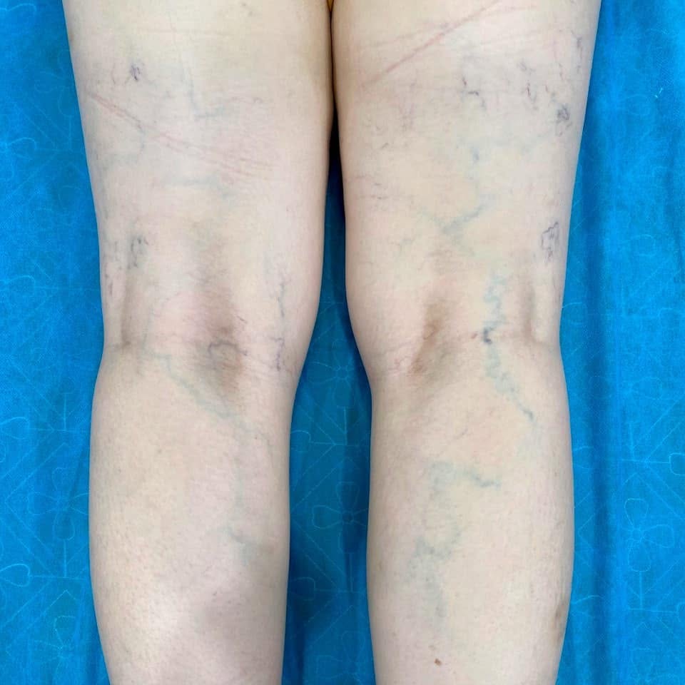Tĩnh mạch chân bị suy giãn trước khi điều trị
