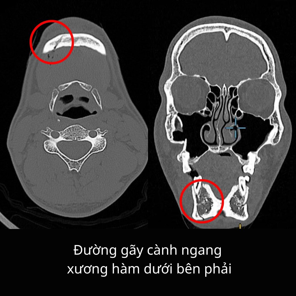 Hình CT gãy cành ngang