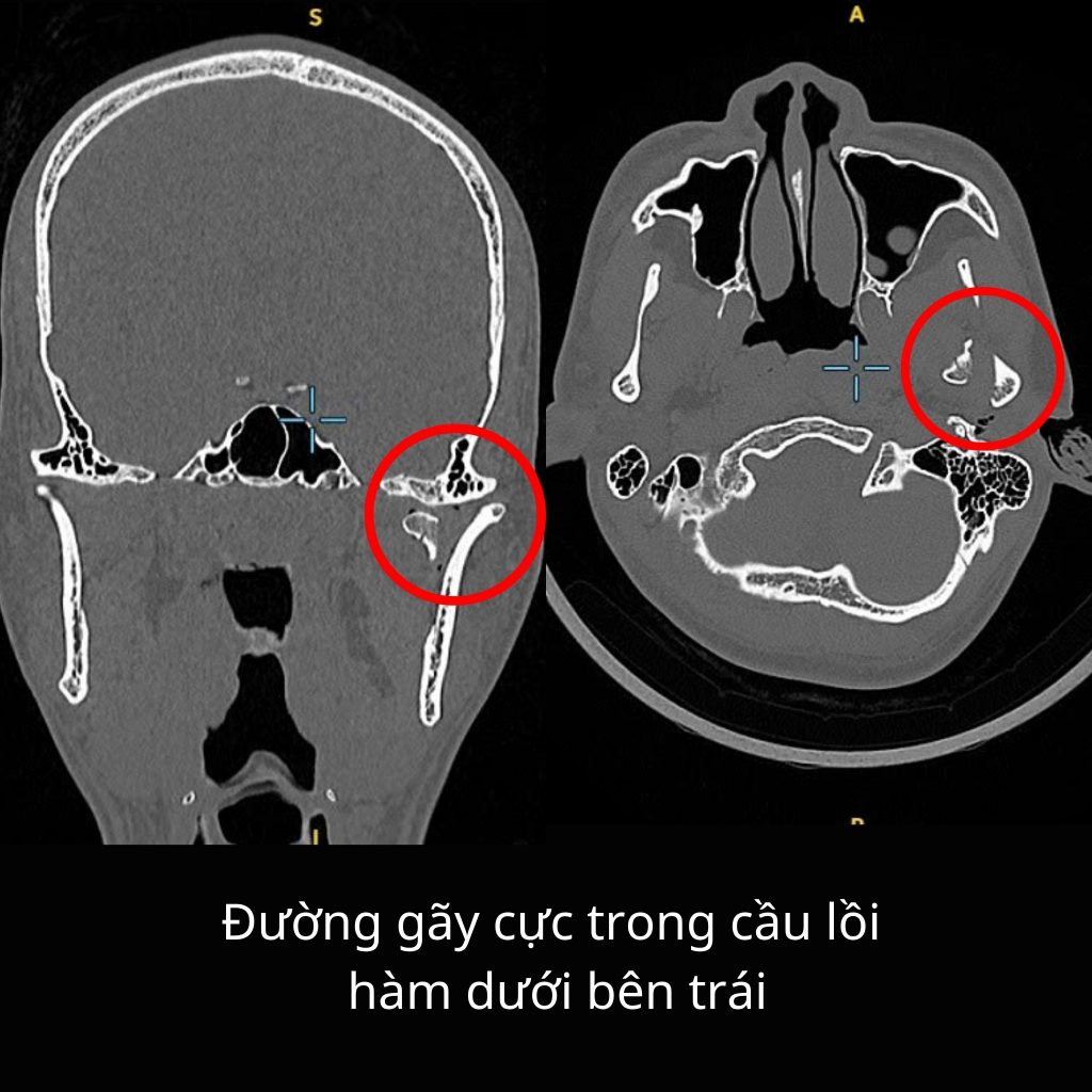 Hình CT gãy cực trong cầu lồi